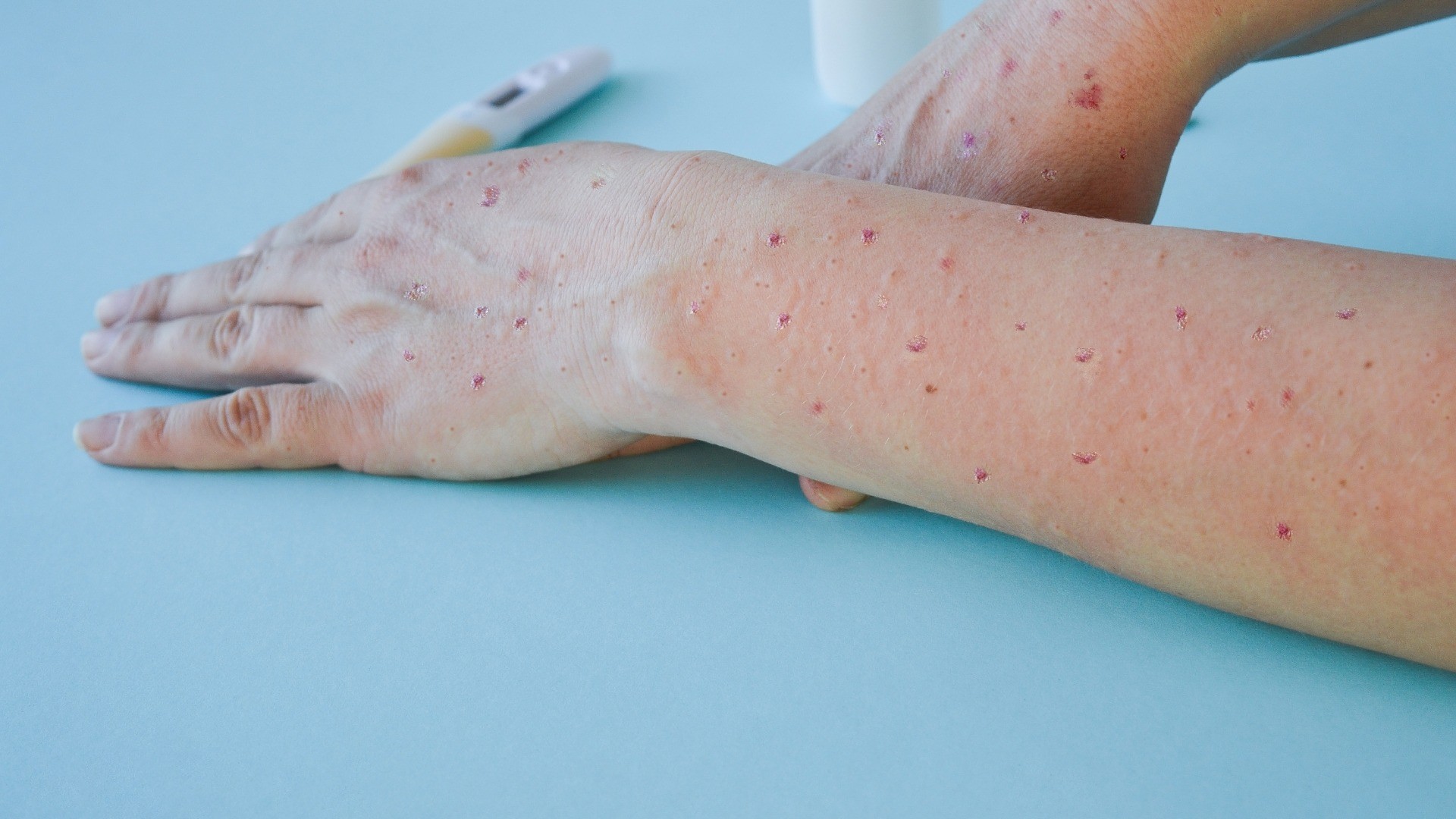 Vaiolo delle scimmie: aumentano i casi, ma sul vaccino manca l'ok da Berna