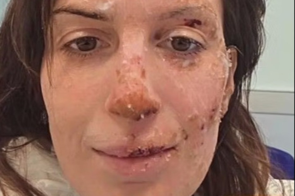 Il coraggio di Eleonora Palmieri: mostra il volto ustionato nel rogo di Crans-Montana