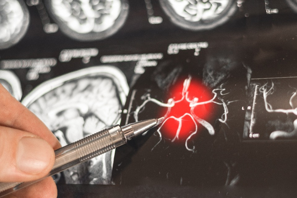 Dai guardiani del cervello una nuova arma contro l'Alzheimer