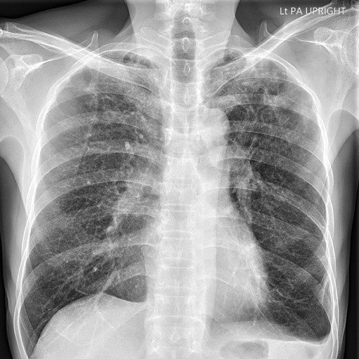 Tubercolosi in una scuola del Vallese: test per gli alunni di cinque classi