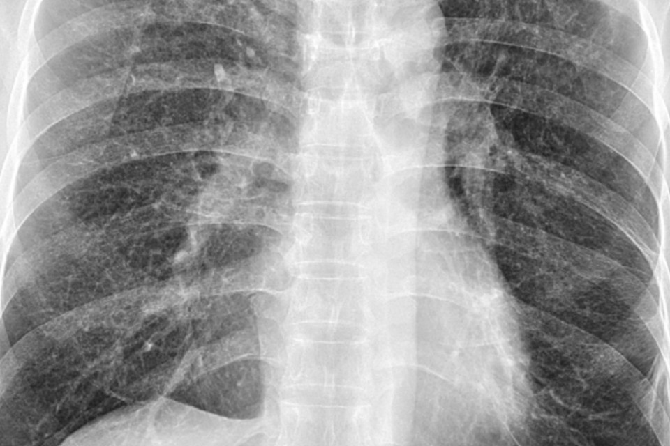 Casi di tubercolosi in Svizzera al livello più alto dal 2018