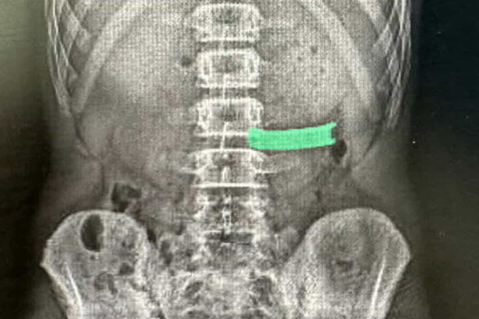 Convive con una leva del freno nella schiena per 3 anni, scoperta da una radiografia